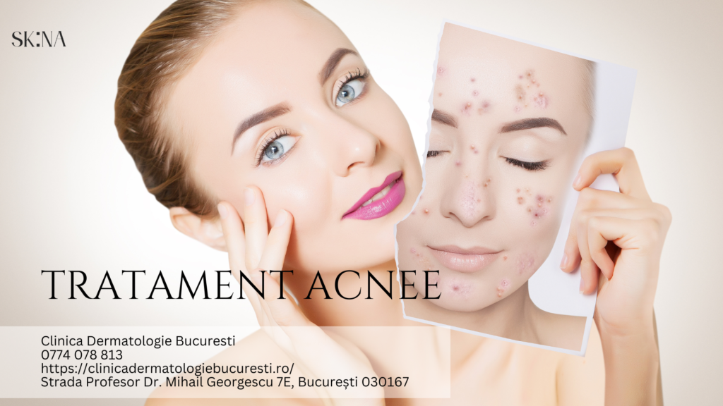 tratament acnee - Dermatologie Bucuresti